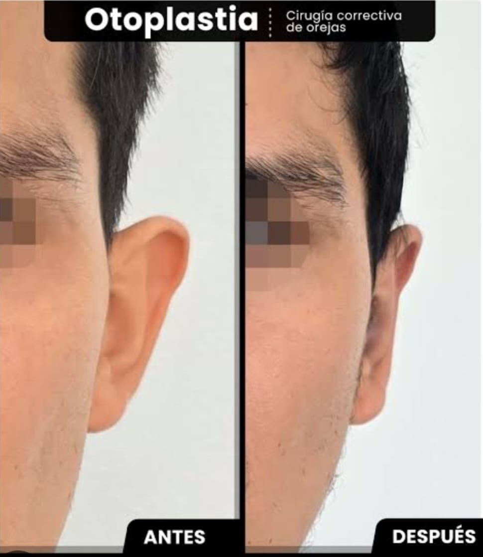 Resultado Otoplastia 2